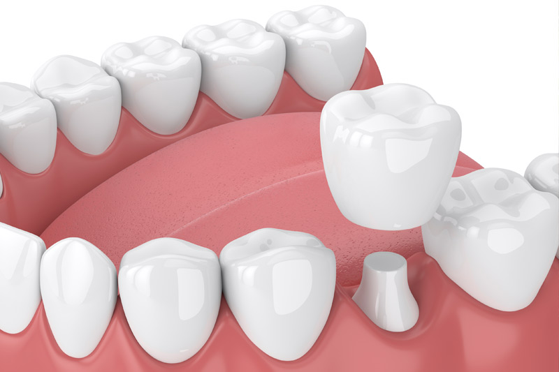 Dental Crowns in La Mirada