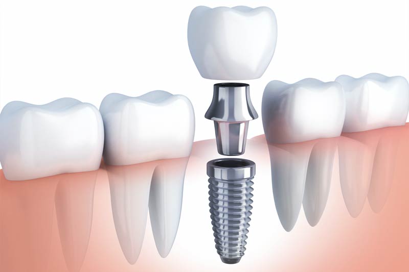 Implants Dentist in La Mirada