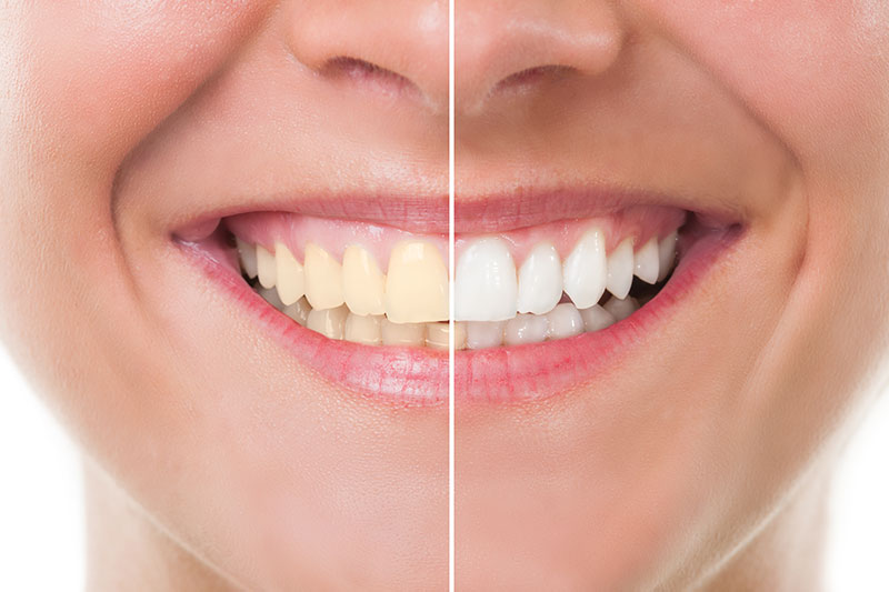 Teeth Whitening in La Mirada