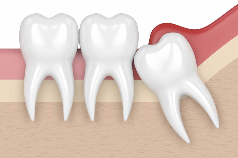 Wisdom Tooth Removal in La Mirada